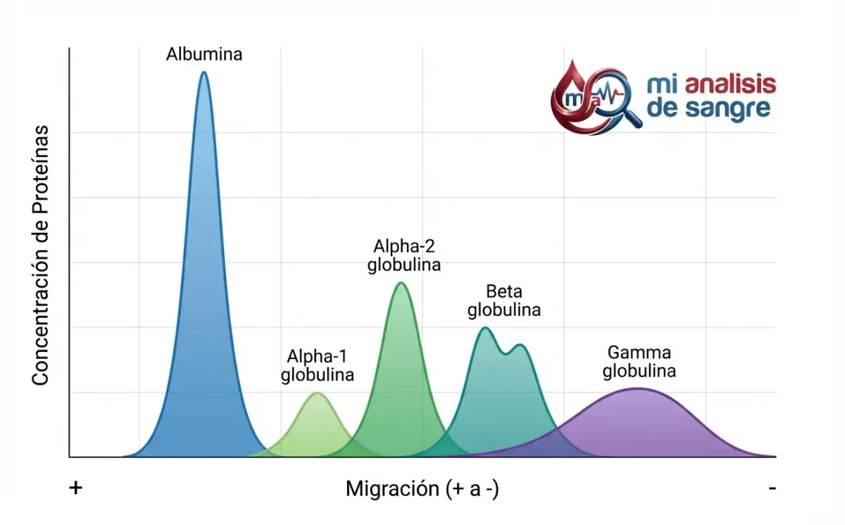 Trazado de electroforesis con un pico alto de albúmina y picos de globulinas alfa-1, alfa-2, beta doble y gamma ancha
